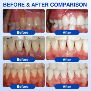 🏅🦷🛡️Jous® GumRevive Periodontal Repair Gel 🧊
 – Drefardthy Store